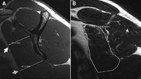 Subscapularis Mri Parameters In The Sagittal Plane A Download