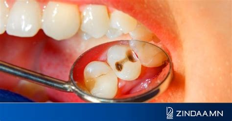 Шүдний цоорол 200 гаруй халдварт өвчний суурь болж, үхэлд хүргэдэг