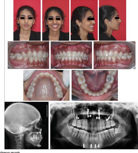 Figure 5 From Surgical Management Of Hyperdivergent Class Ii Malocclusion With Vertical