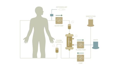 Therapeutic Plasma Exchange Lifespan Edge
