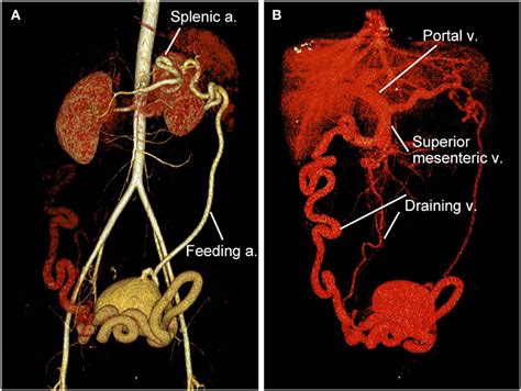 Frontiers Case Report A Rare Abdominopelvic Arteriovenous