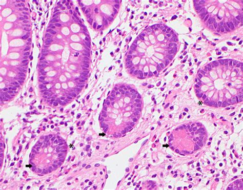 Traumatic Neuroma Pathology Outlines