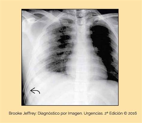 Contusi N Pulmonar