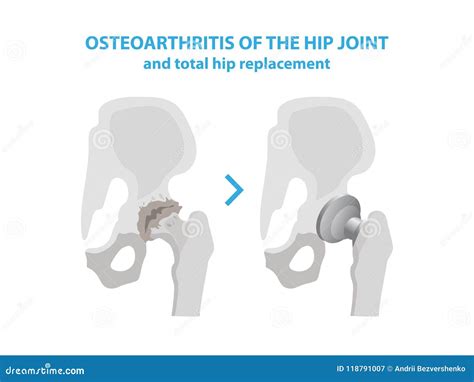 Osteoarthritis of the Hip Joint and Hip Replacement Surgery Medical ...