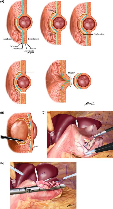 Laparoscopic Endoscopic Cooperative Surgery LECS For The