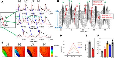 Two Distinct Locations Of Av Block A Sample Traces Of Rapid Pacing Download Scientific