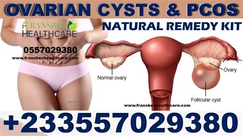 Natural Solution For Ovarian Cyst In Ghana