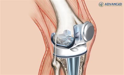 Knee Cartilage Replacement