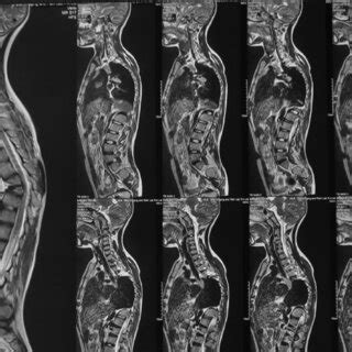 Magnetic Resonance Imaging Of The Spine Case 4 Showing Lesion At D7 9