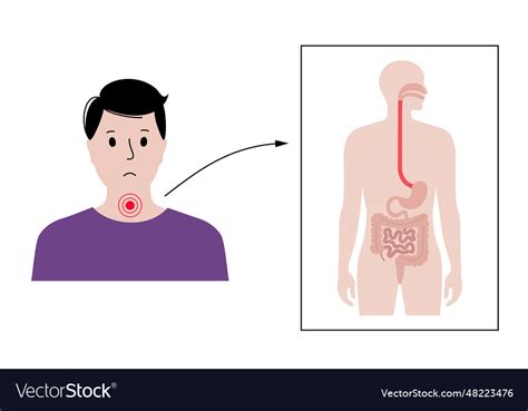 Dysphagia Medical Poster Royalty Free Vector Image