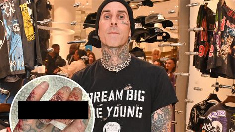 Travis Barker Revela Una Impactante Lesi N En La Mano Despu S Del