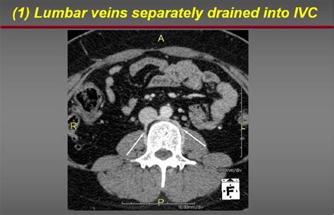 Figure 1 From Evaluation Of Lumbar Venous Anatomy With Routine