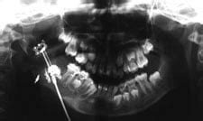 Distraction Osteogenesis | Face & Jaw Surgery Center