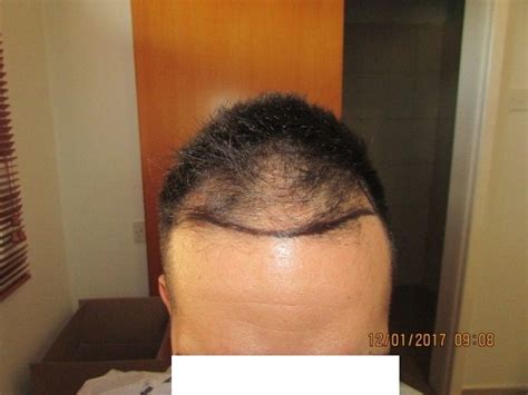 Hair Transplant Fue Result 0 8 Months Nw3 Hdc Hair Transplant