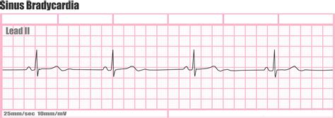 Bradycardia Sinus Bradycardia Causes Symptoms Diagnosis Treatment