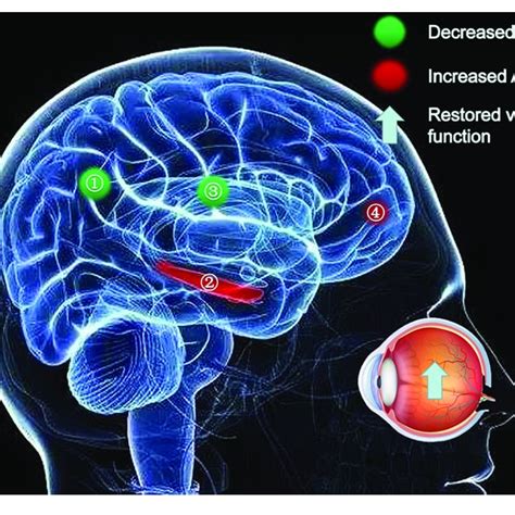 Significant Differences In Spontaneous Brain Activity Between The