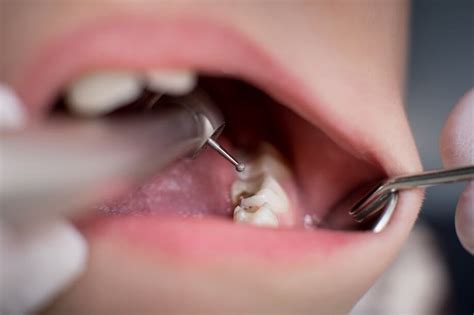 How Long Do Composite Fillings Last Sunshine Dentistry