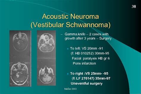 Acoustic Neuroma Vestibular Schwannoma Diagnosis and treatment Per