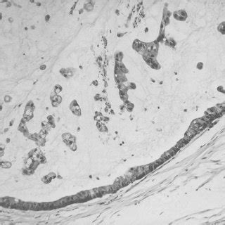 (Right) Mucocutaneous junction illustrating dysplastic glandular mucosa. | Download Scientific ...