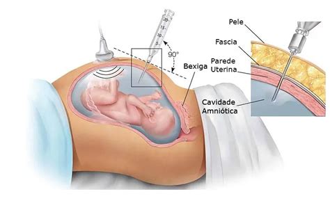 Transfus O Sangu Nea Fetali Medicina Fetal E