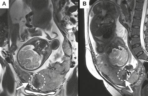 Scielo Brasil Placental Adhesion Disorder Magnetic Resonance Imaging