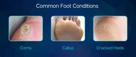 Corns Callus And Cracked Heels Bespoke Health