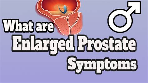 What Are Enlarged Prostate Symptoms Youtube