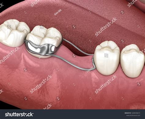 Space Maintainer Unilateral Keeps Teeth Shift Stock Illustration