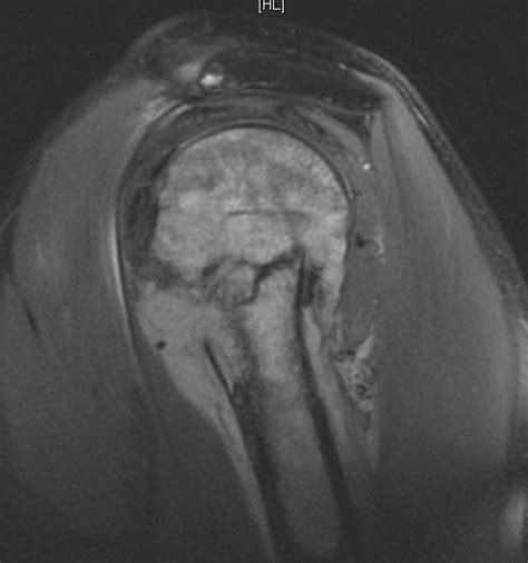 Mri Humerus