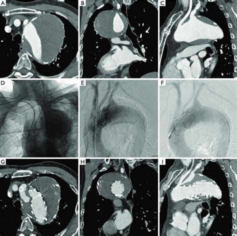 Giant Thoracic Aortic Aneurysm Taa Involving Supra Aortic Branches Download Scientific