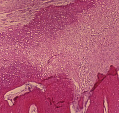 Histology Of Osteosarcoma