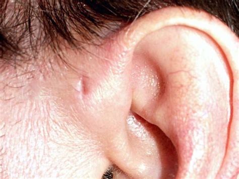 Abscess Ear Lobe