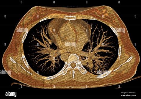 Normal Pulmonary Radiography Fotos Und Bildmaterial In Hoher