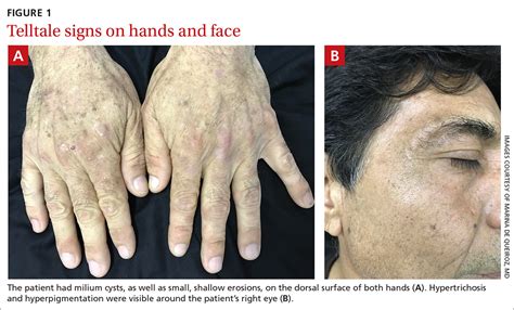 Hypertrichosis Treatment Before And After