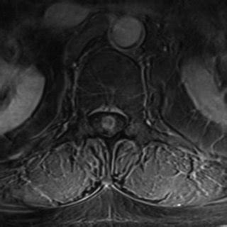 Axial Contrast Enhanced T Weighted Magnetic Resonance Image