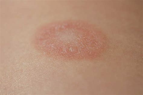 Lichen Planus Symptoms Causes Treatments Clear Skin Clinic Hot Sex Picture