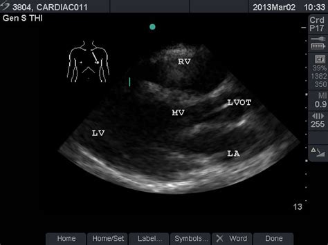 Echocardiography For Emergency Physicians Sonoguide