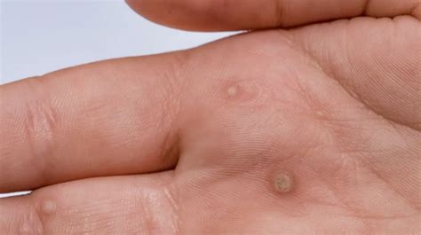 Identify Different Types Of Warts And Their Treatment Method Nutrition By Eve