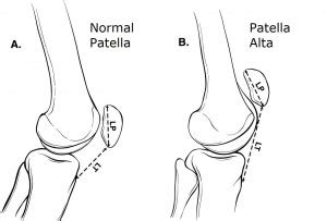 Patella Dislocation Treatment Mike Smith Knee Surgeon Patella Alta