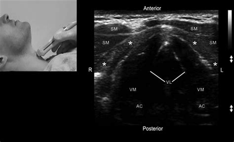 Use Of Sonography For Airway Assessment Singh Journal Of