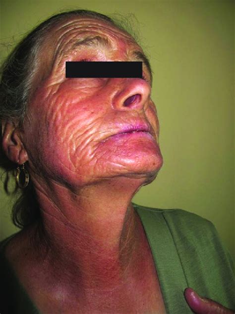 Photosensitivity from voriconazole with severe cheilitis and lip ...