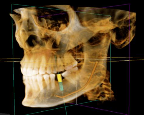 Tomografía Cone Beam 3D Clinica Maxi Dental