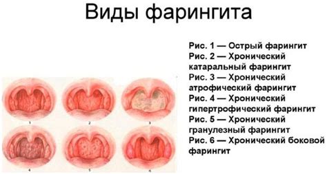 Фарингит: симптомы, фото, лечение фарингита