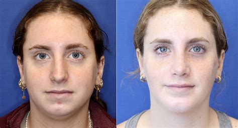 Buccal Fat Removal Chin Implant Rhinoplasty Photos Chevy Chase Md Patient 14485