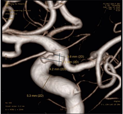 3D CTA Three Dimensional Reconstruction Of Computed Tomographic