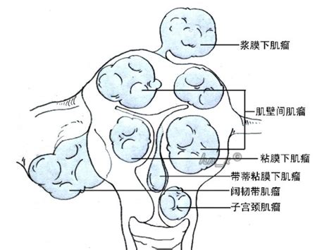 子宫肌瘤囊性病变 搜狗百科