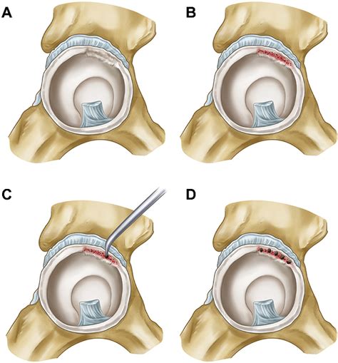 Figure 2 From Tissue Regrowth And Its Vascularization Through Bone Marrow Stimulation