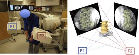 In Vivo Dynamic Changes Of Dimensions In The Lumbar Intervertebral