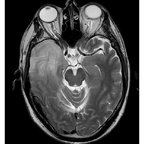 Pre And Post Operative Glioblastoma Imaging A Pre Operative Axial