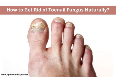 How To Get Rid Of Toenail Fungus Naturally 8 Remedies You Should Try Ayur Health Tips